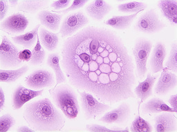 From Beans to Breakthroughs: Making CAR-T Therapy Accessible