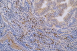Cancer before cancer: the inflamed boundaries