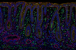 Intercepting colorectal cancer at the extremes of age