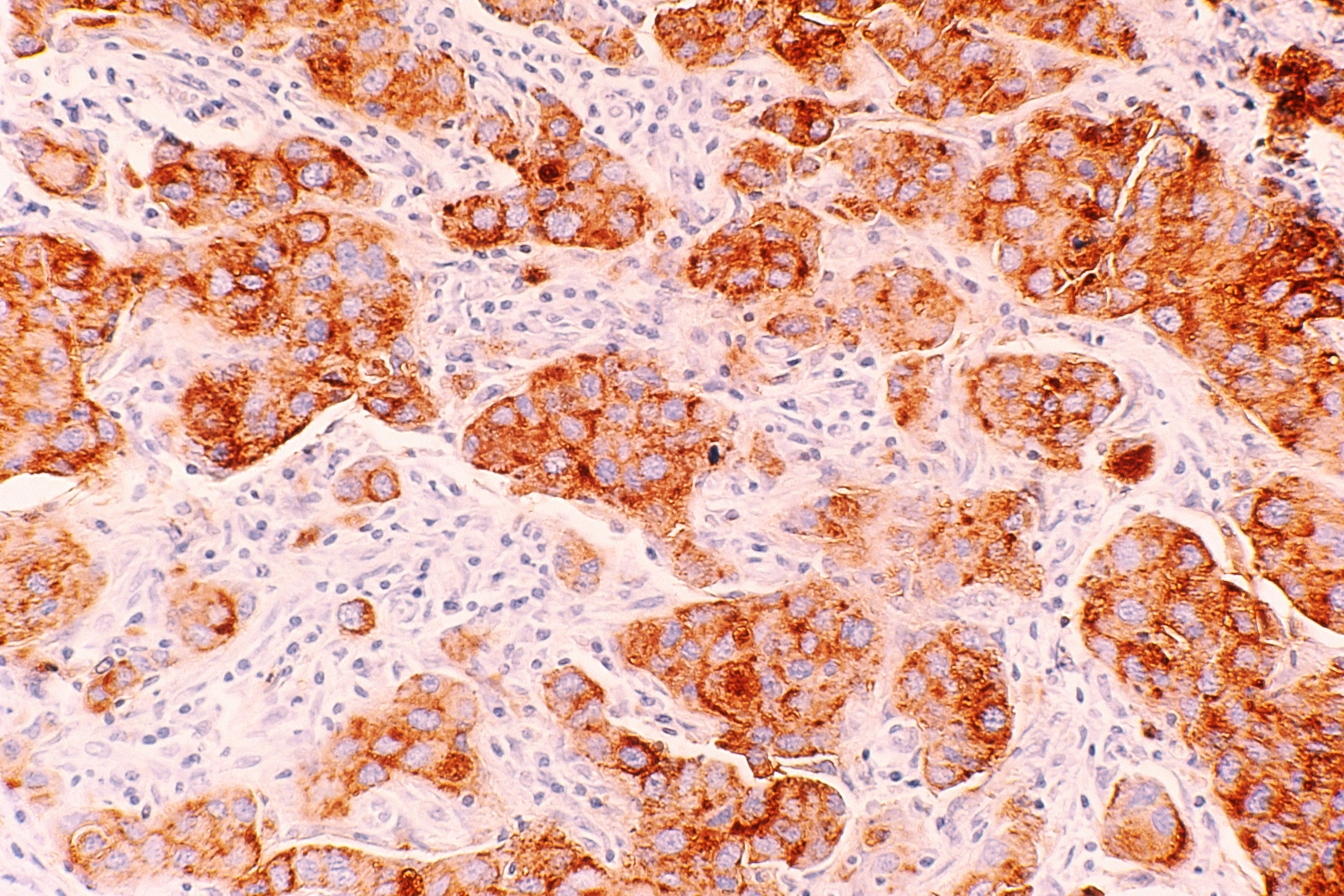 Ensuring dignity in terminal cancer: the global palliative care equity fund