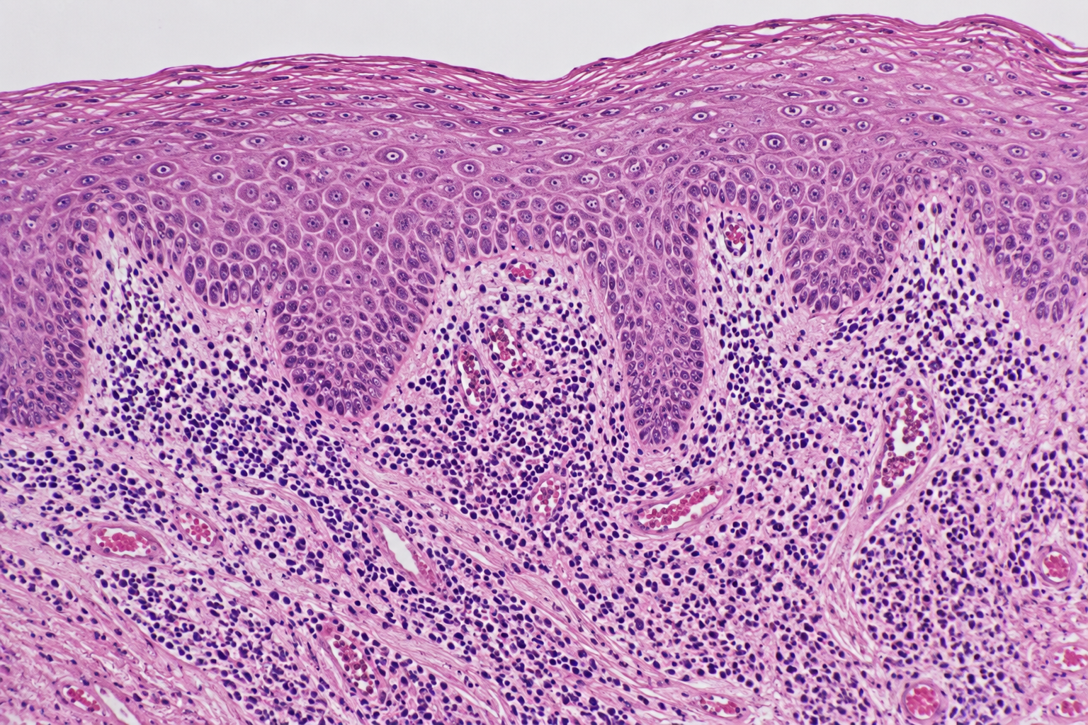 Discovering how to Prevent Cancer Isn’t Enough: We Can’t Allow Cancer to Be a Manifestation of Poverty