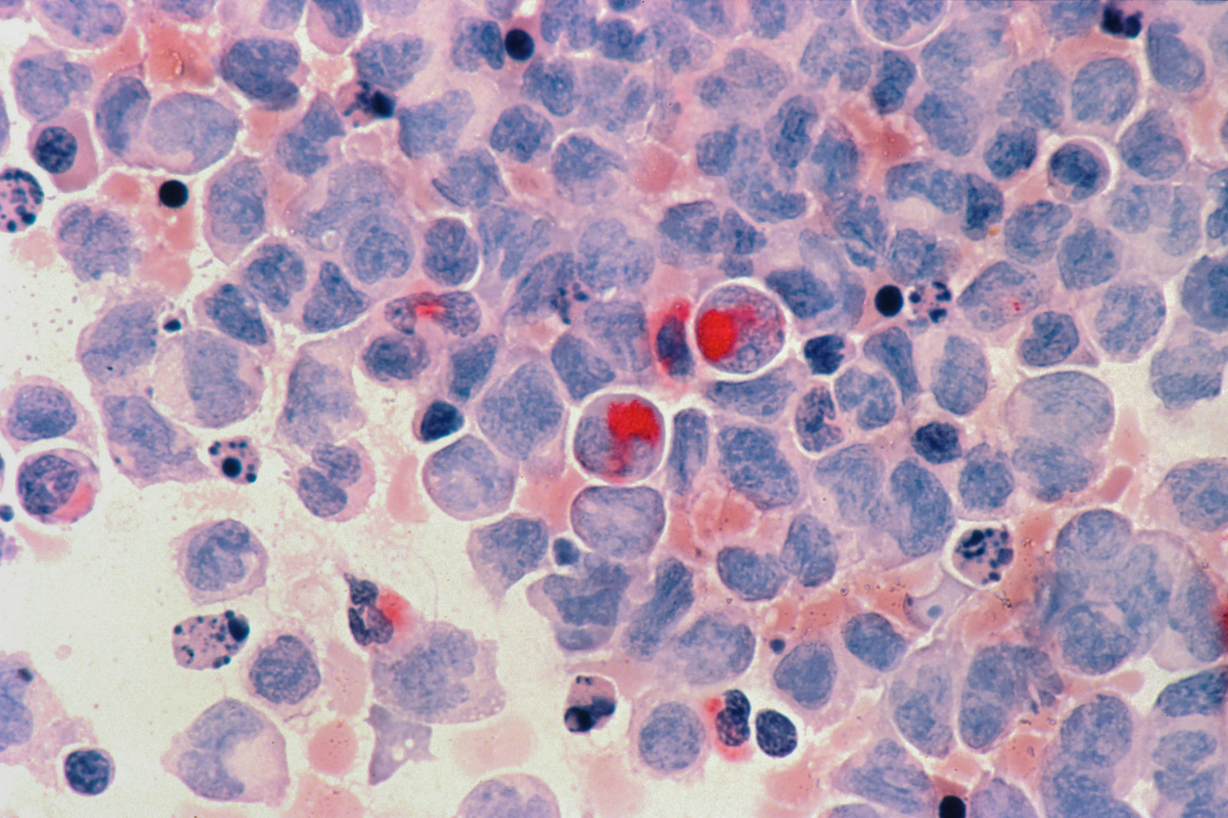 Surviving Cancer, But at What Cost?